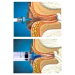 Acu-Life Ear Wax Removal Syringe - Image 3